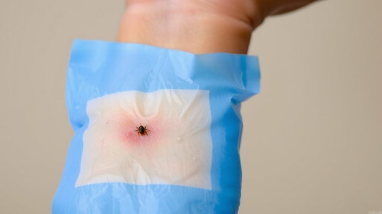 cold compress for insect bites